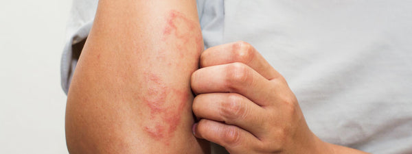 What’s the Difference Between Eczema and Psoriasis? - VITAL+ Pharmacy